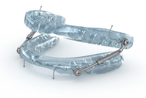 Close-up of oral appliance used to treat sleep apnea